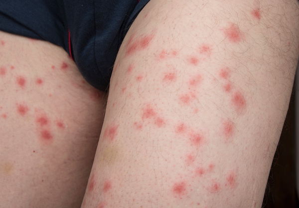 Multiple mosquito bites on skin