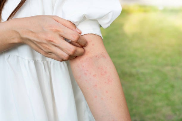 Woman scratching a cluster of red mosquito bites on her upper arm outdoors