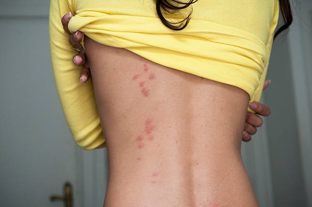 Woman lifting her yellow shirt to reveal a cluster of red bed bug bites across her lower back
