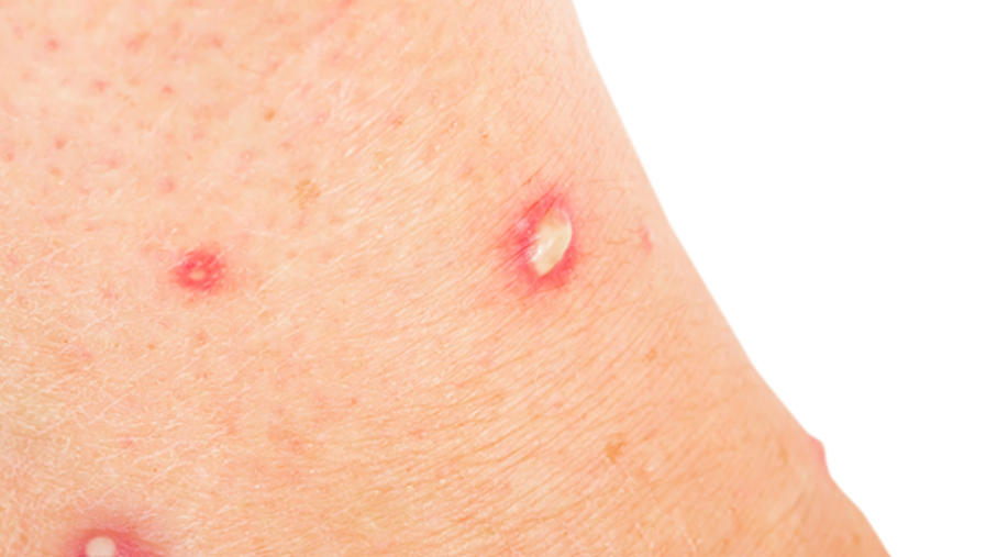 Cluster of small red ant bites on human skin showing the typical line pattern of ant bites