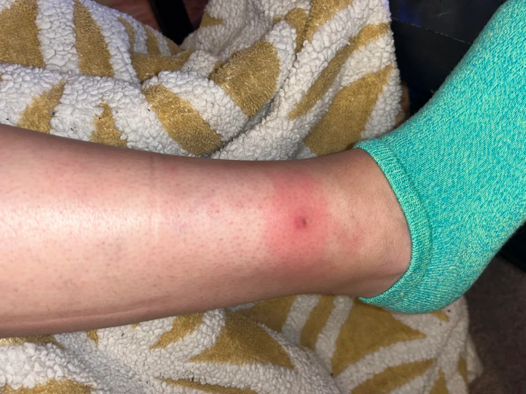 Reddish spider bite mark near a person's ankle showing typical spider bite appearance