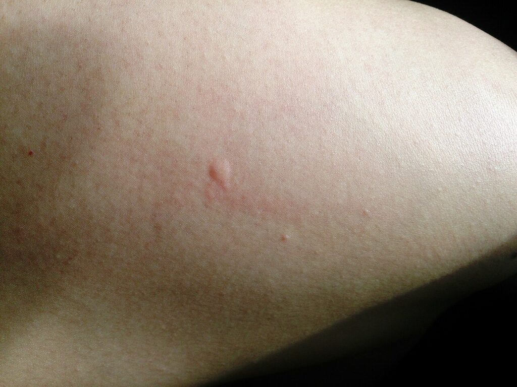 Mosquito bite on the thigh  