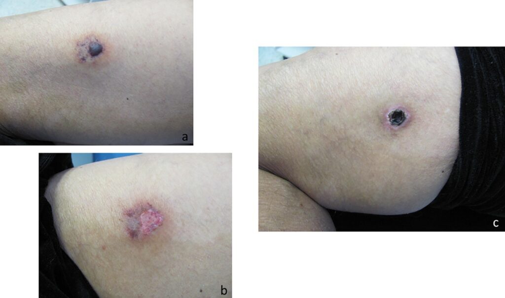 Evolution of a necrotic wound resulting from a recluse spider bite