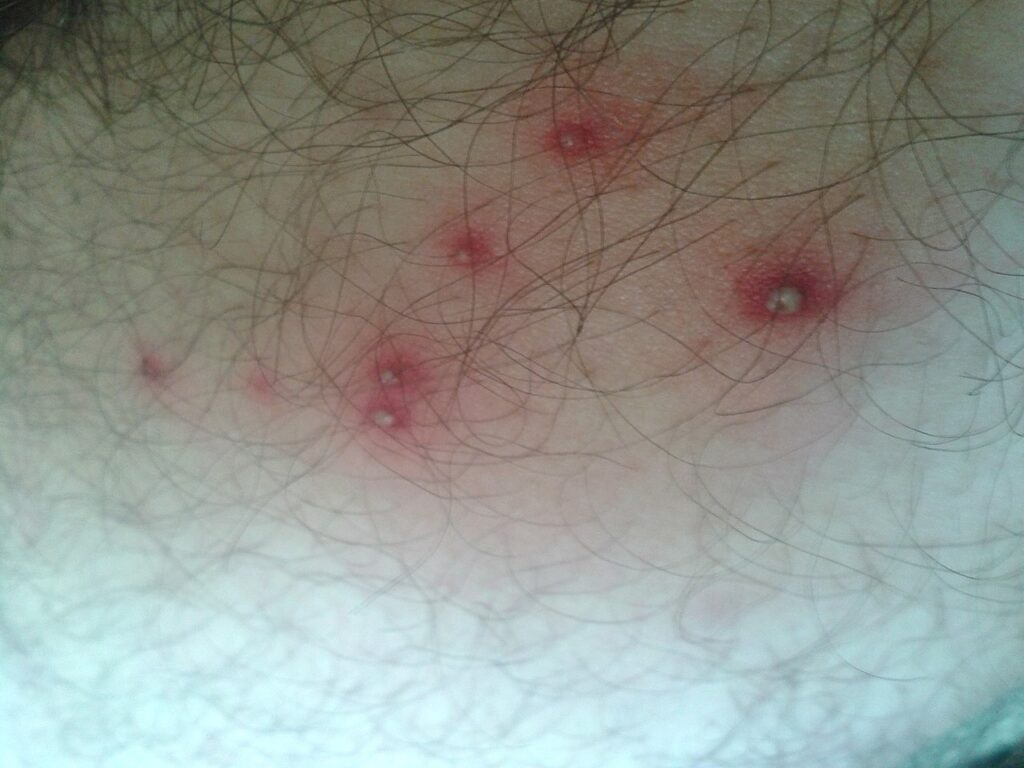 A cluster of bed bug bites on the skin
