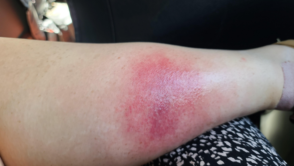 A person's forearm showing a large red, swollen welt from a hornet sting.