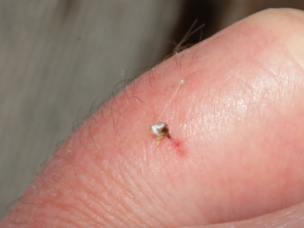 Close-up of a bee stinger embedded in reddened skin on a person's hand. 