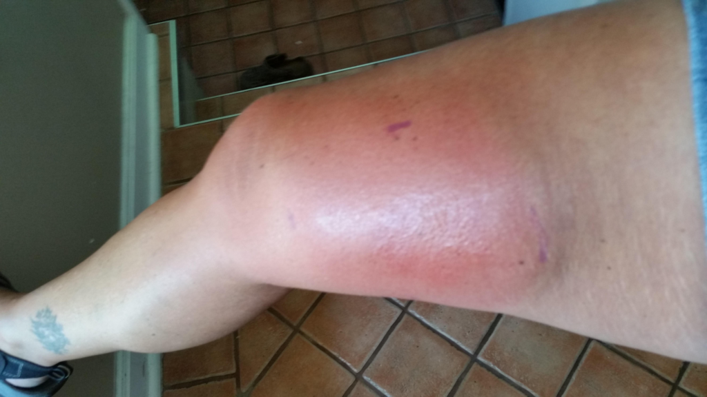 A person's leg showing significant redness and swelling from a wasp sting reaction.