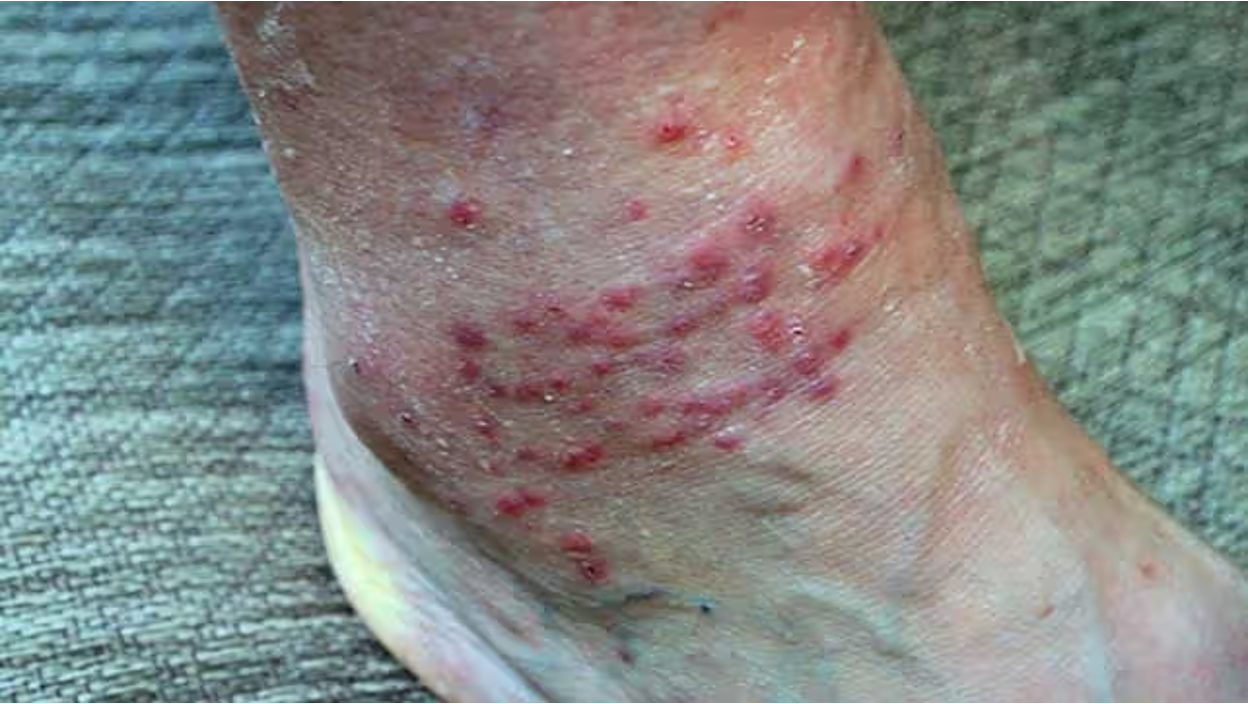 Close-up of a person's ankle and foot showing a cluster of inflamed red bumps and blisters from chigger bites, against a woven textured surface. (Image courtesy of Healthline)