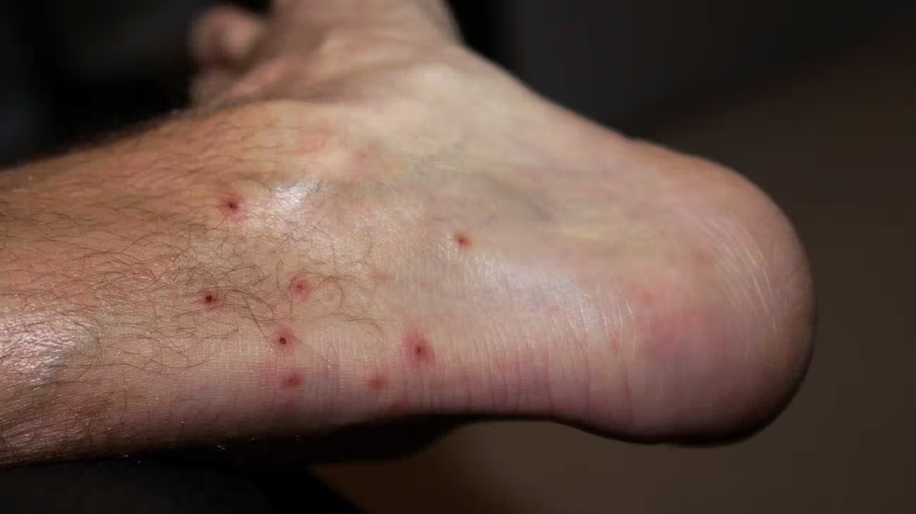 Close-up of a person's foot and ankle showing scattered chigger bite marks across the skin, against a softly blurred dark background. 
