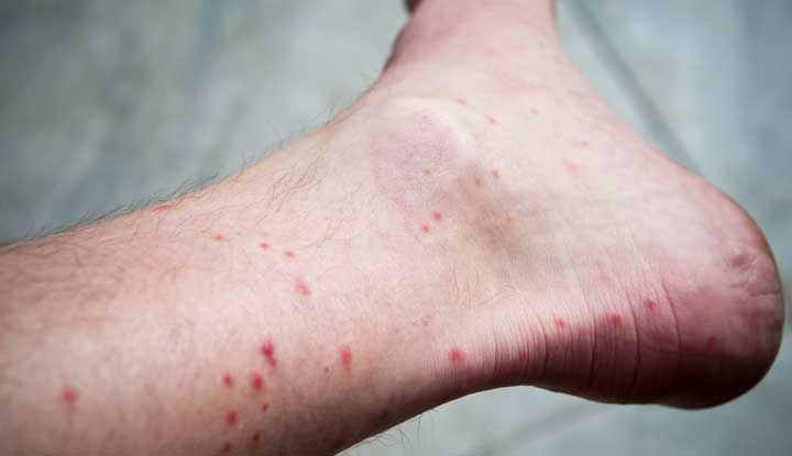 Flea bites on lower leg showing small red bumps and a larger raised welt across the skin, against a softly blurred neutral background. 