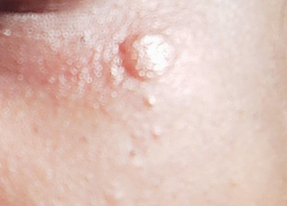 A swollen wasp bite