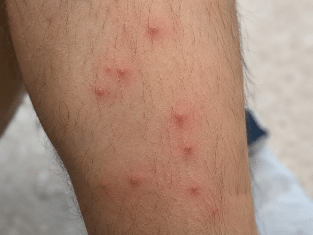 Close-up view showing ant bites on a person’s leg. 