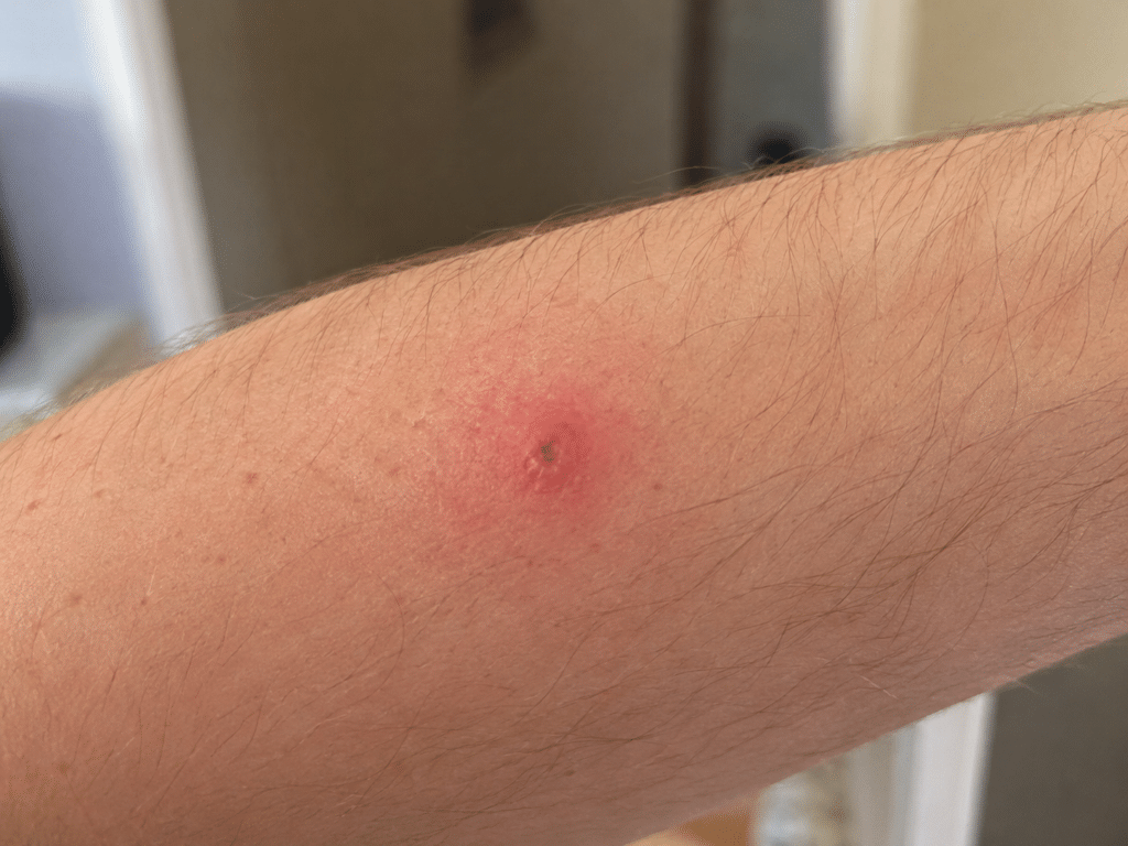 Close-up of a person’s arm, showing a spider bite. 