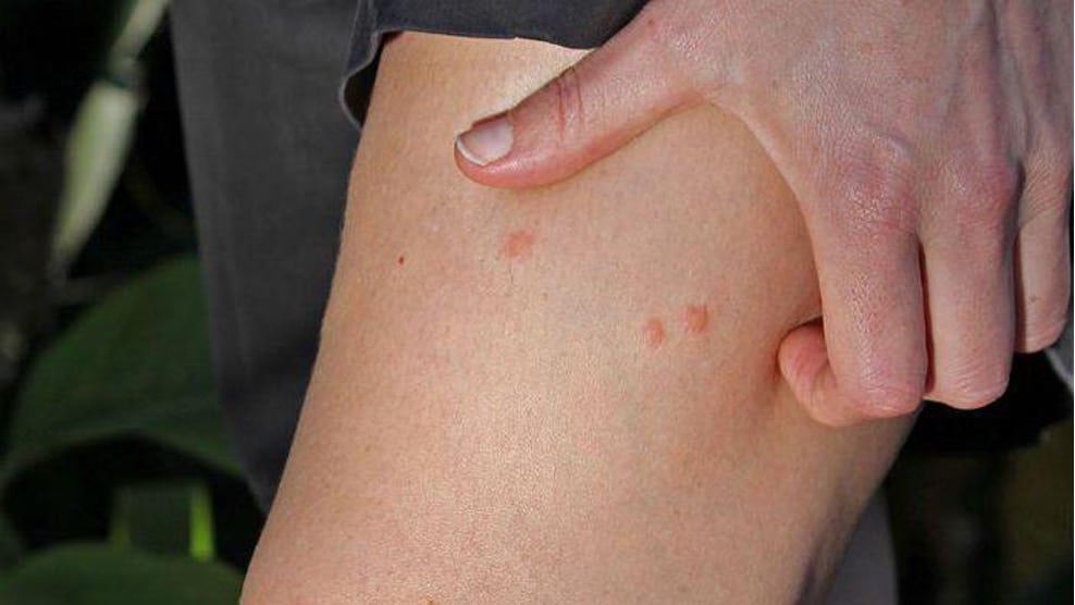 Hand pulling up gray shorts to show three small red bite marks on the thigh. (Image courtesy of Roboflow Universe)