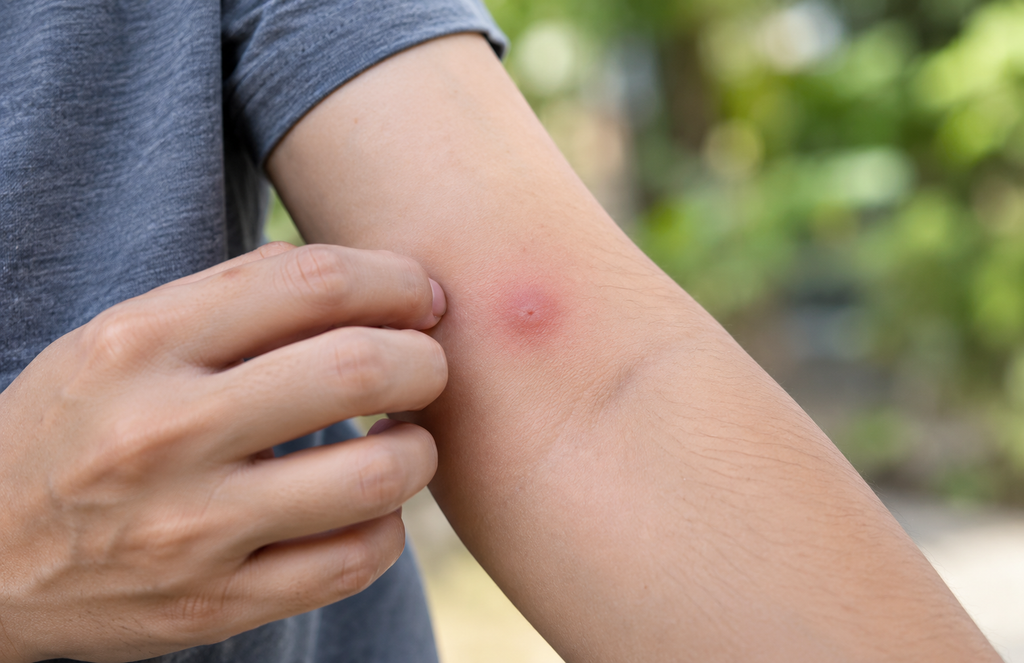 Close-up view of a mosquito bite on a person’s arm, showing the raised welt.