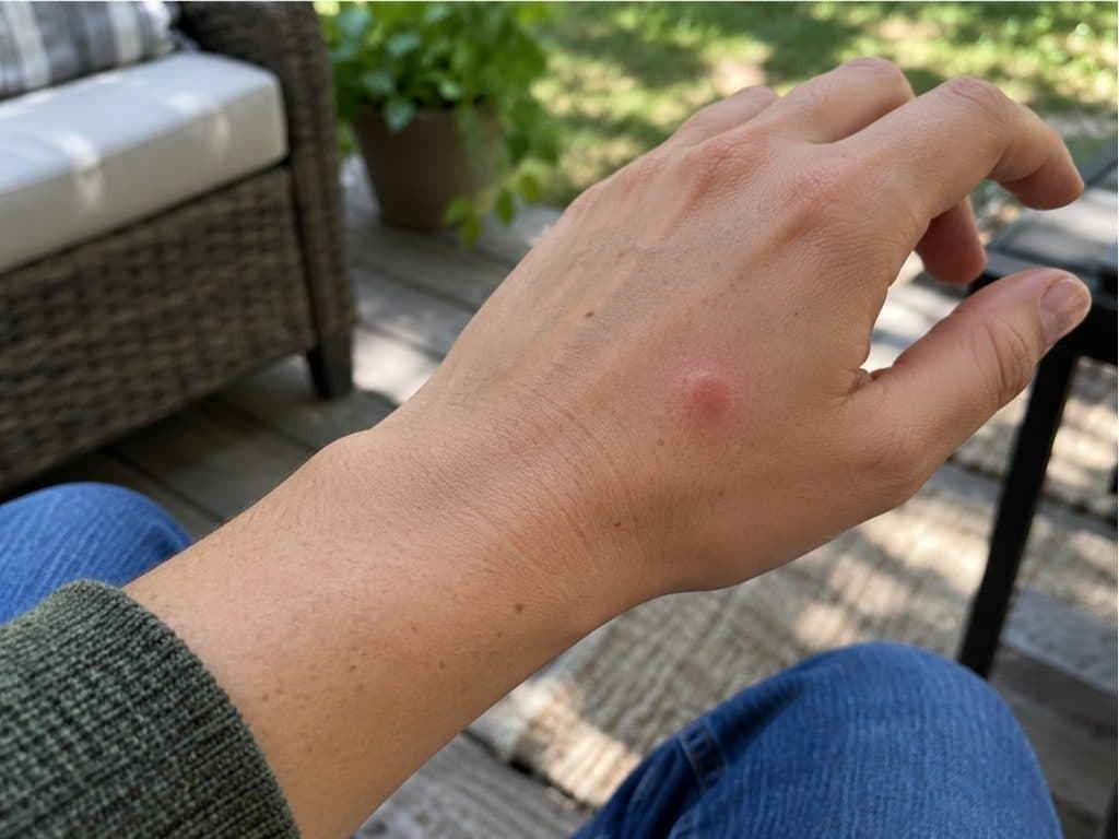 Raised reddish welt from a gnat on the back of a hand on an outdoor patio
