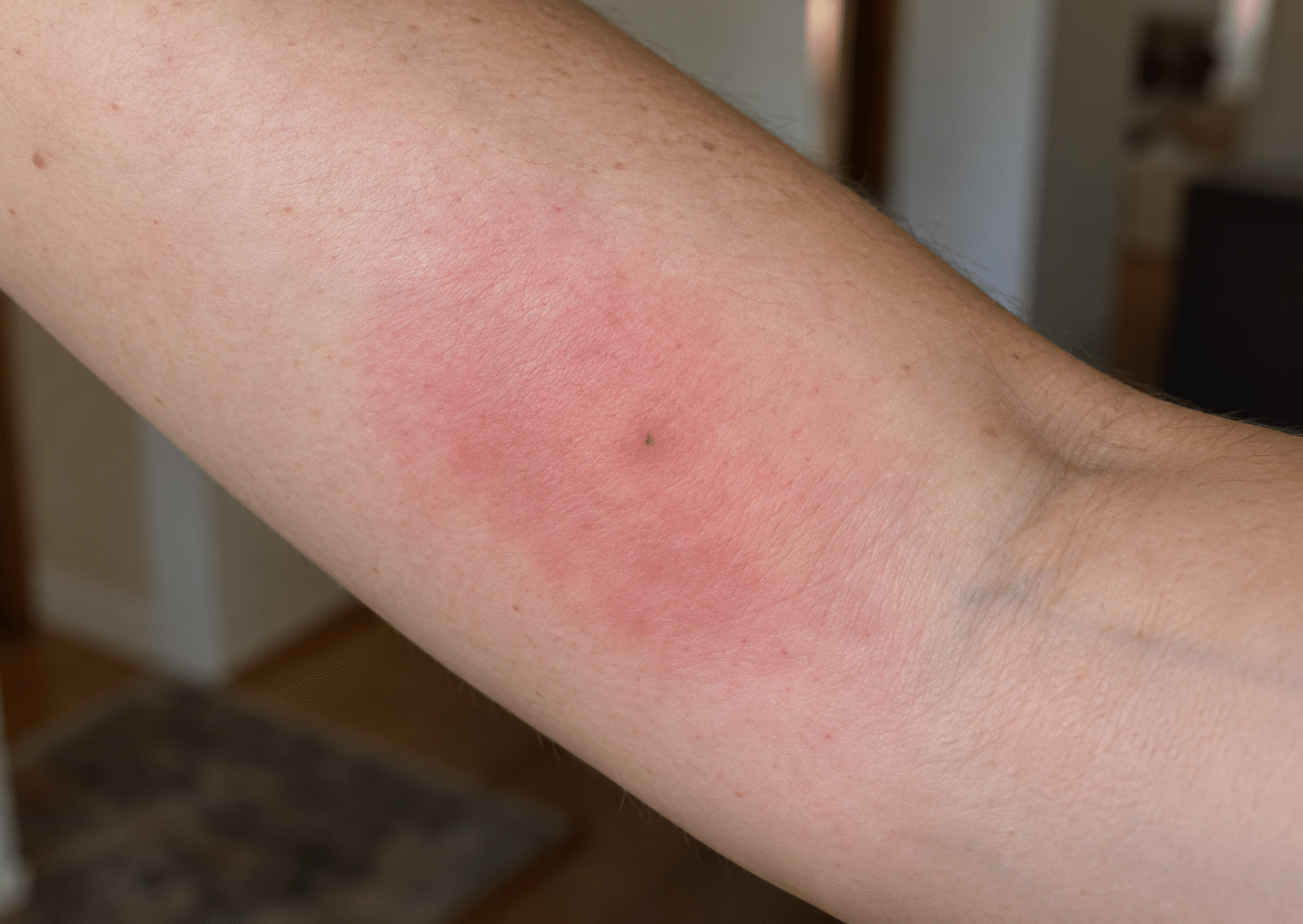 Inner forearm with a gnat bite showing a tiny dark puncture surrounded by a wide red, inflamed patch.