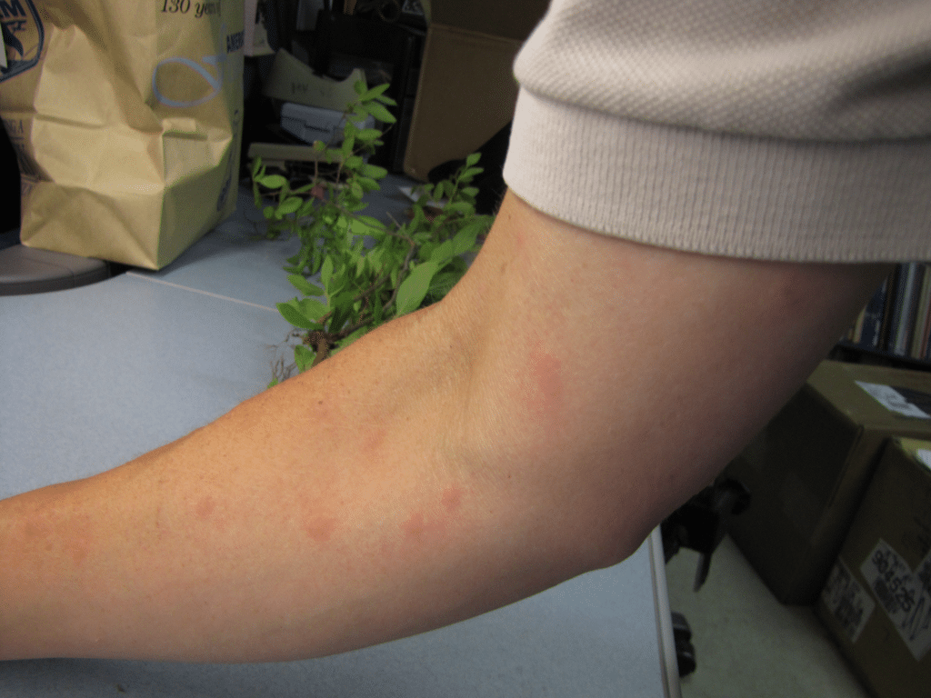 Forearm and inner elbow with several scattered pink, puffy mosquito bite bumps on exposed skin.