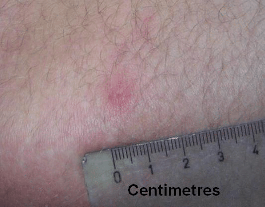 Small red gnat bite with a central dot on hairy skin beside a ruler labeled "Centimeters."