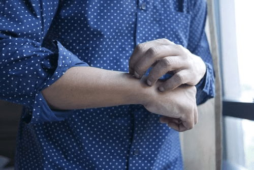 A person in a blue polka-dot shirt scratches an itchy bite on their wrist.