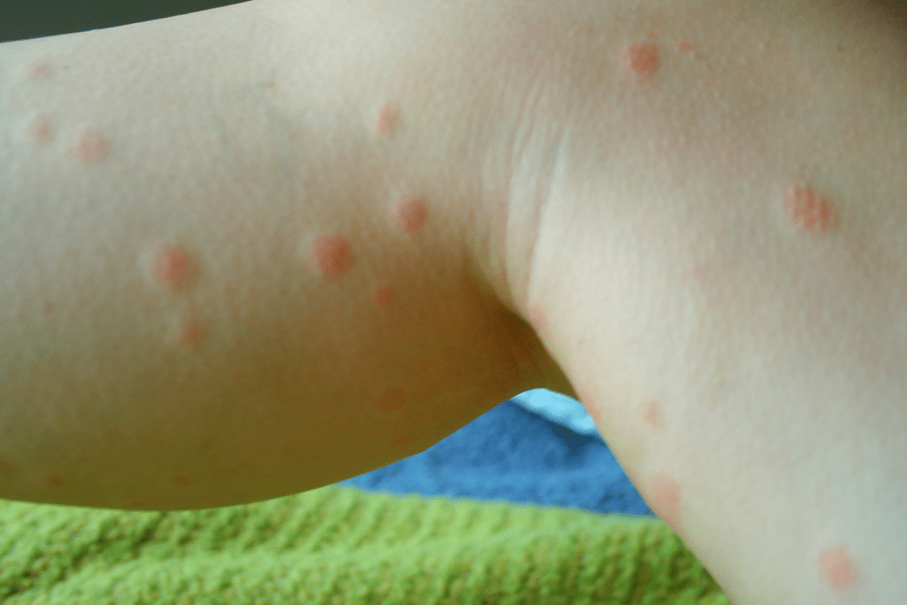 Scattered red, pimple-like chigger bites across the bend of a leg resting on a green towel.